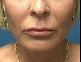Lip Lift Before & After Patient #1293