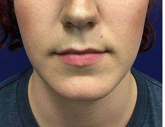 Lip Lift Before & After Patient #1296