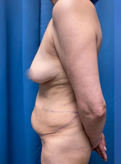Tummy Tuck Before & After Patient #253