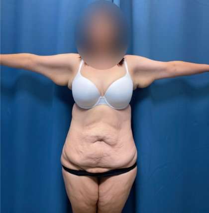 Tummy Tuck Before & After Patient #260
