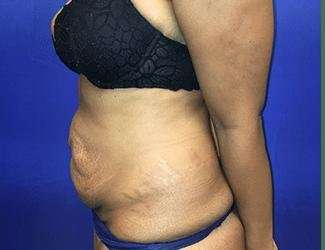 Tummy Tuck Before & After Patient #349