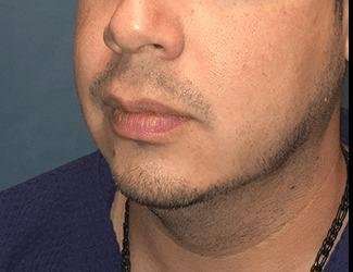 Facial Implants Before & After Patient #1403