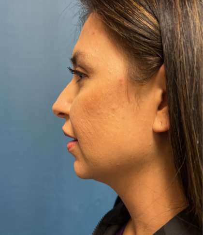 Facial Implants Before & After Patient #1486