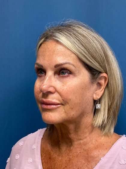 Facelift And Necklift Before & After Patient #1497
