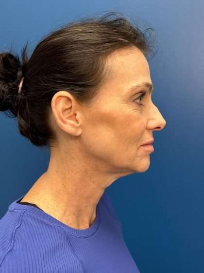 Facelift And Necklift Before & After Patient #1506