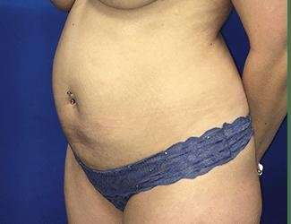 Tummy Tuck Before & After Patient #358