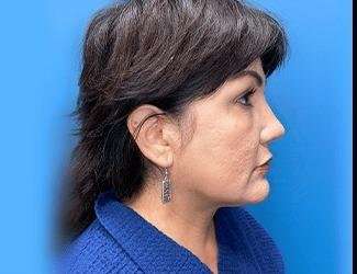 Facelift And Necklift Before & After Patient #1513