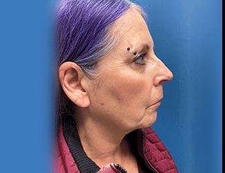 Facelift And Necklift Before & After Patient #1520
