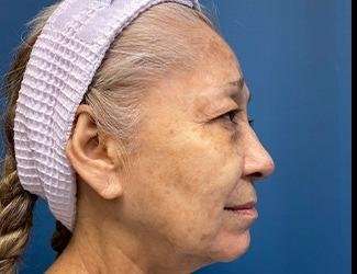 Facelift And Necklift Before & After Patient #1531