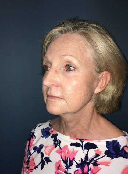 Facelift And Necklift Before & After Patient #1549