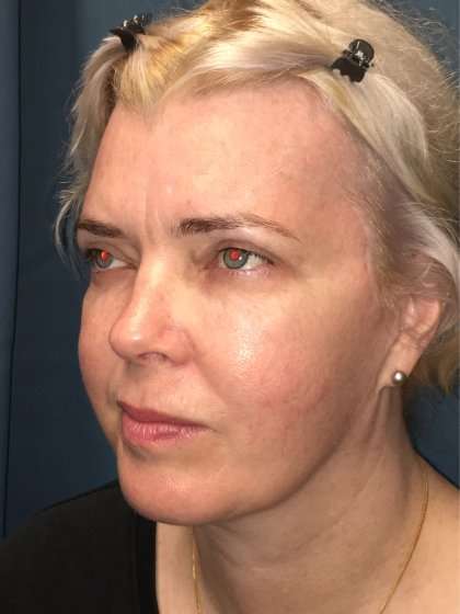 Facelift And Necklift Before & After Patient #1582
