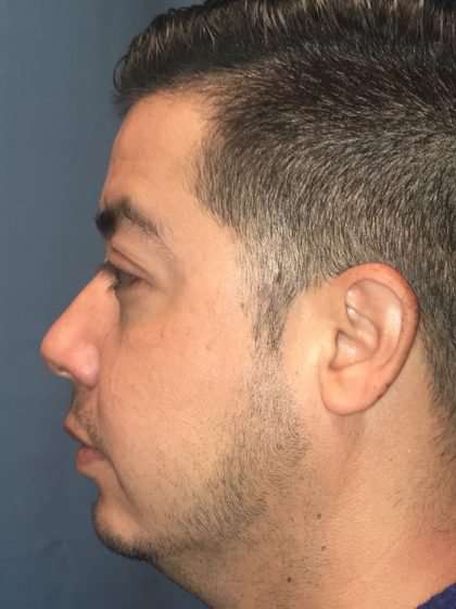 Chin Implant Before & After Patient #1604