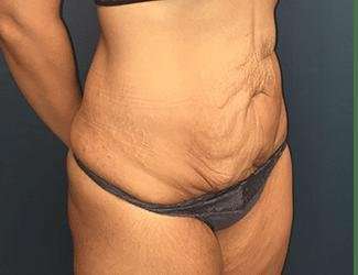 Tummy Tuck Before & After Patient #369