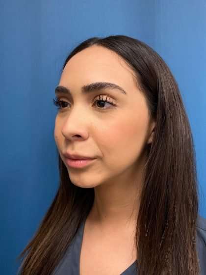 Chin Implant Before & After Patient #1622