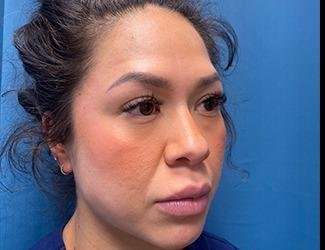 Buccal Fat Removal Before & After Patient #1643
