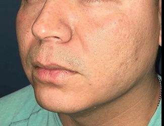 Buccal Fat Removal Before & After Patient #1656