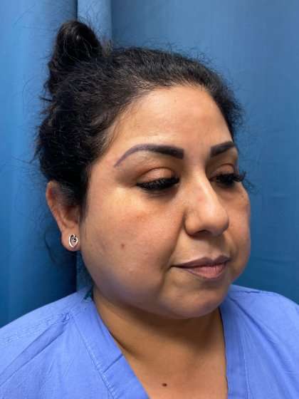 Buccal Fat Removal Before & After Patient #1663