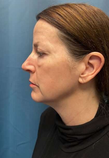 Brow Lift Before & After Patient #1674