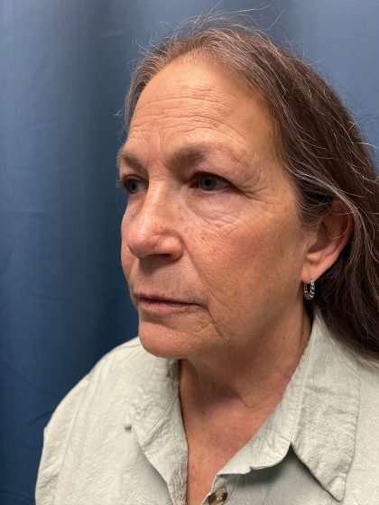 Brow Lift Before & After Patient #1685