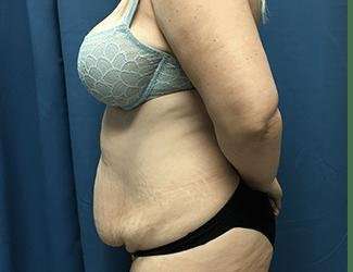 Tummy Tuck Before & After Patient #380