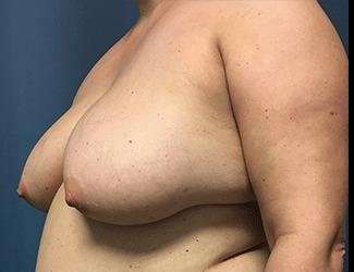 Breast Reduction Before & After Patient #1727