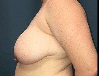 Breast Reduction Before & After Patient #1738