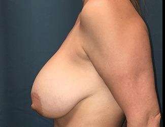 Breast Reduction Before & After Patient #1749
