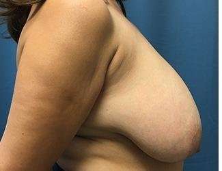 Breast Reduction Before & After Patient #1782