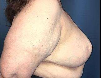 Breast Reduction Before & After Patient #1815