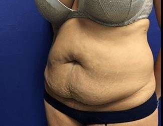 Tummy Tuck Before & After Patient #395