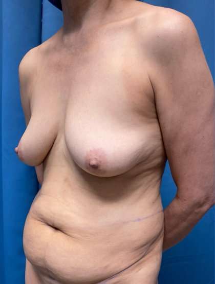 Breast Lift Before & After Patient #1861