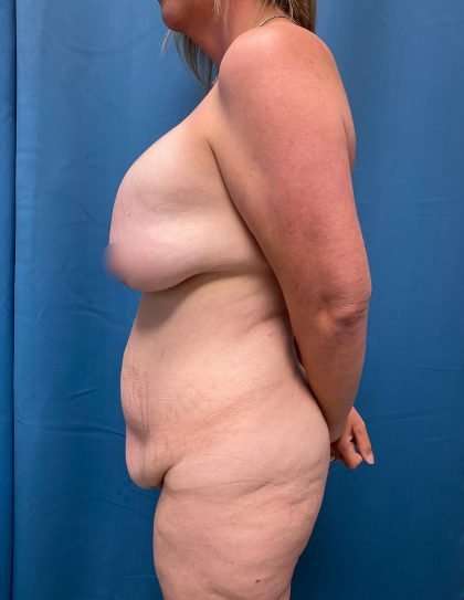 Breast Lift Before & After Patient #1894