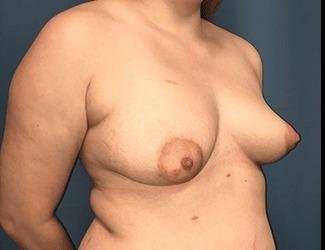 Breast Lift Before & After Patient #1903
