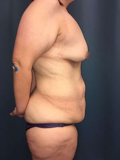 Tummy Tuck Before & After Patient #406
