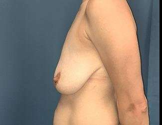 Breast Lift Before & After Patient #1923