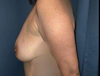 Breast Lift Before & After Patient #1965