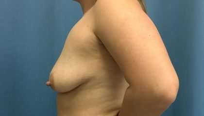 Breast Lift Before & After Patient #2011