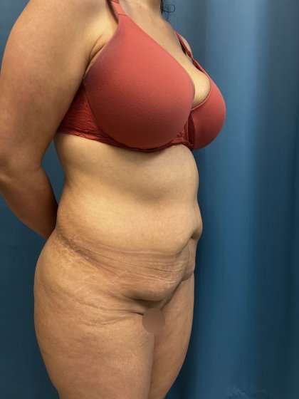 Tummy Tuck Before & After Patient #417
