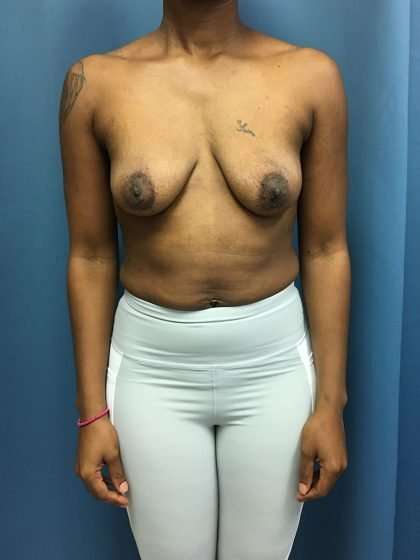 Breast Lift Before & After Patient #2016