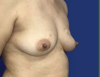Breast Augmentation Before & After Patient #2069