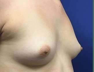 Breast Augmentation Before & After Patient #2102