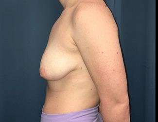 Breast Augmentation Before & After Patient #2111