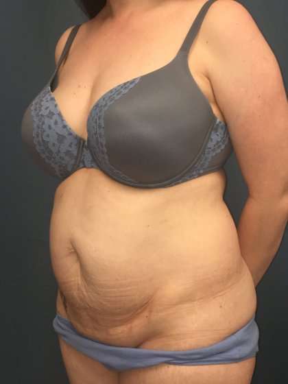 Tummy Tuck Before & After Patient #428