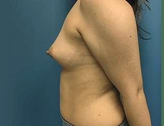 Breast Augmentation Before & After Patient #2153