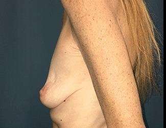 Breast Augmentation Before & After Patient #2162