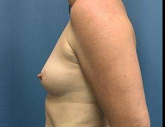 Breast Augmentation Before & After Patient #2191
