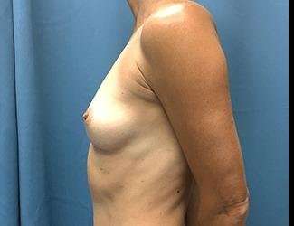 Breast Augmentation Before & After Patient #2202