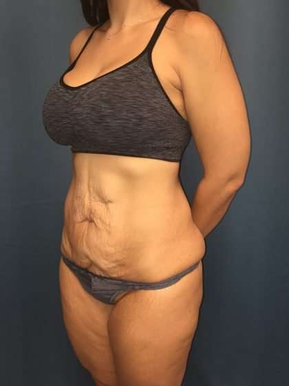 Tummy Tuck Before & After Patient #439