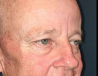 Blepharoplasty Before & After Patient #2251
