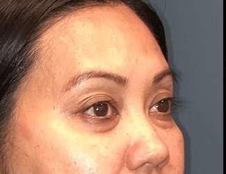 Blepharoplasty Before & After Patient #2260